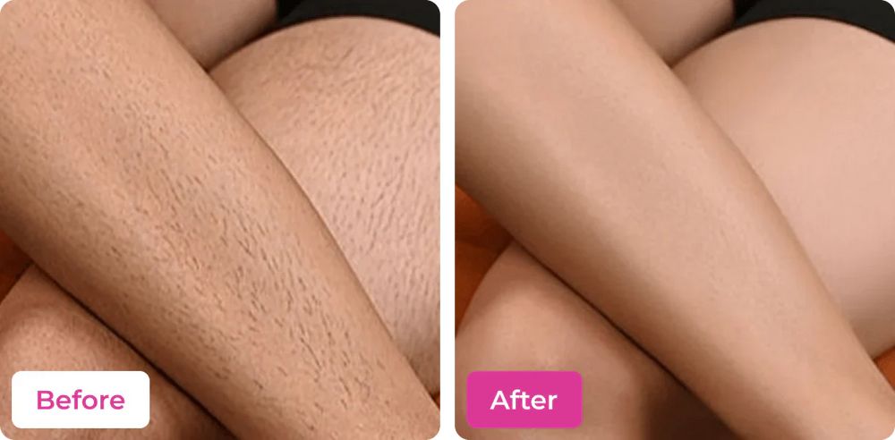Side-by-side before and after comparison of leg hair removal using Meeoow Club body hair mask, showing legs with short, visible hair stubble vs completely smooth, hairless skin.