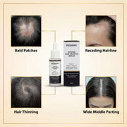 ProSkire Intense Hair Growth Serum for hair thinning, bald patches, receding hairline and wide middle parting, helping support thicker, healthier-looking hair for men and women