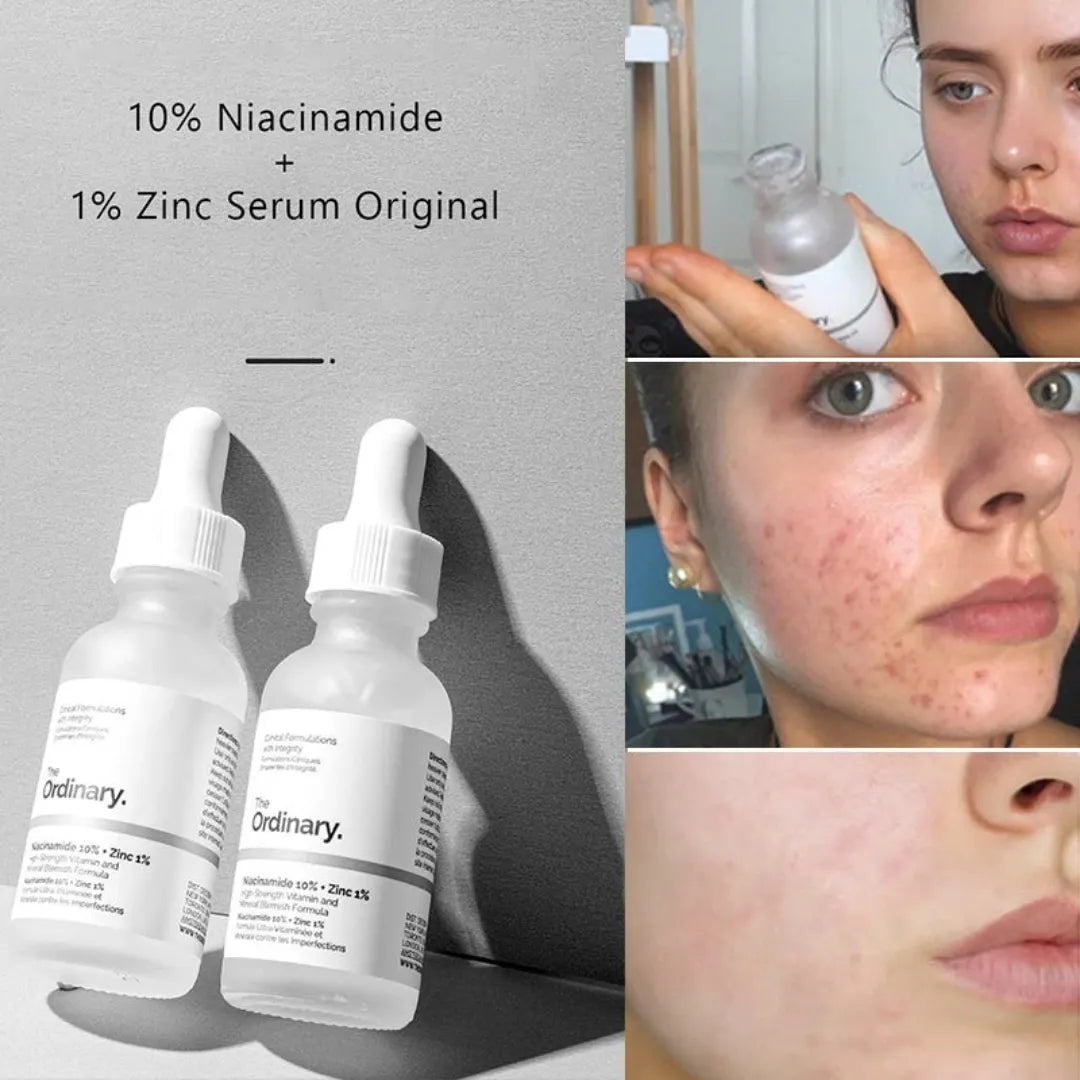 The Ordinary Niacinamide Zinc serum before and after skin improvement for acne marks